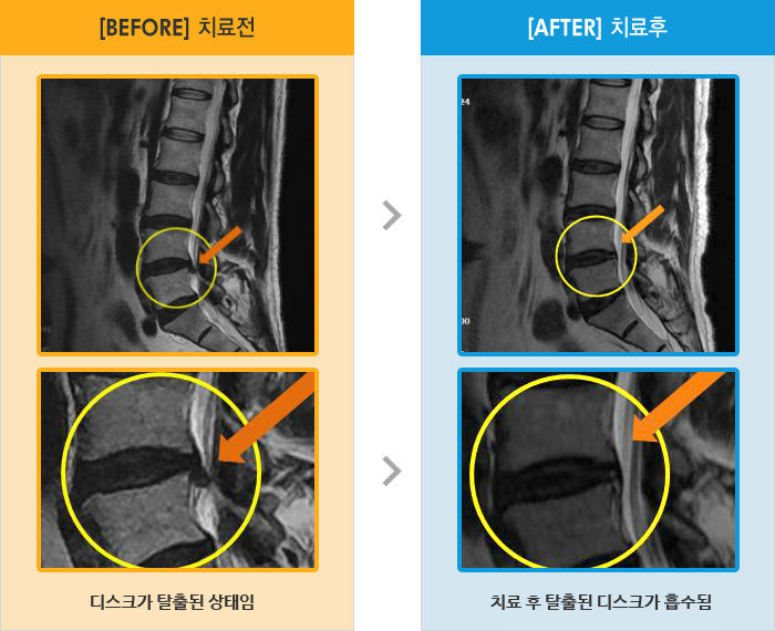 자생한방병원 치료사례 MRI로 보는 치료결과-걸을 때 힘이 잘 안들어가고 다리 올릴 때 통증