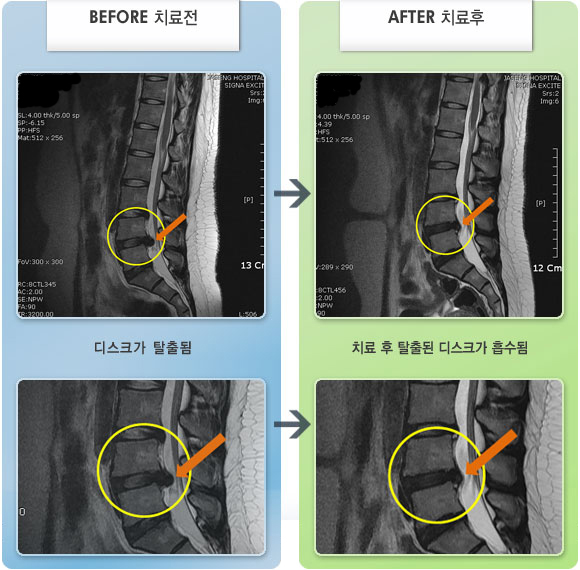 자생한방병원 치료사례 MRI로 보는 치료결과-오른쪽 다리 저림과 통증이 앉을 때마다 증가