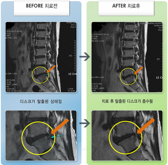 자생한방병원 치료사례 MRI로 보는 치료결과-우측 엉덩이 통증 및 허벅지에서 발목까지 이르는 하지 방산통으로 저리고 시큰거림이 심함