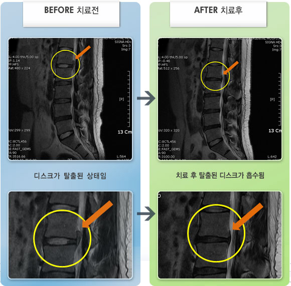 자생한방병원 치료사례 MRI로 보는 치료결과-좌측 다리 앞, 옆쪽으로 통증과 감각이 둔함