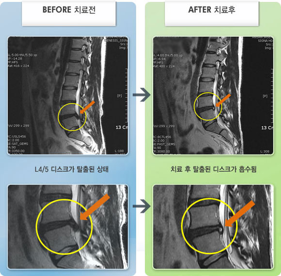자생한방병원 치료사례 MRI로 보는 치료결과-보행시 왼쪽 종아리와 발 부위가 당기고 저림 