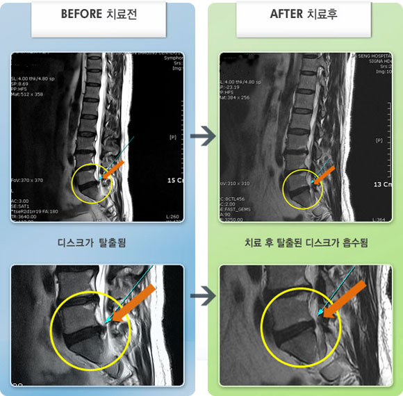 자생한방병원 치료사례 MRI로 보는 치료결과-허리 통증이 심했고, 장시간 앉아 있으면 통증이 증가