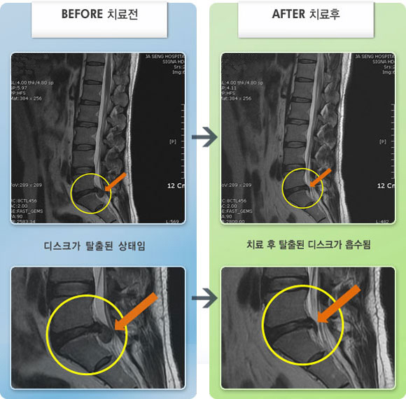 자생한방병원 치료사례 MRI로 보는 치료결과-우측 허리와 엉치, 다리가 저리고 당기는 통증