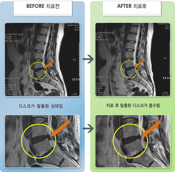자생한방병원 치료사례 MRI로 보는 치료결과-허리 통증이 심하여 허리를 잡고 보행하고 앉았다 일어나기 힘든 상태