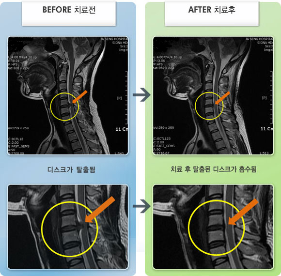 자생한방병원 치료사례 MRI로 보는 치료결과-목과 양쪽 팔 통증으로 잠을 잘 이루지 못함