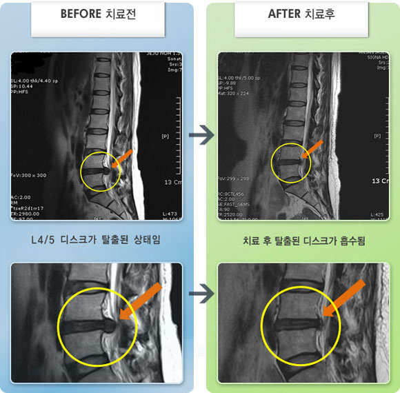 자생한방병원 치료사례 MRI로 보는 치료결과-30분 정도 걸으면 통증 때문에 더 이상 걷기 힘든 상태