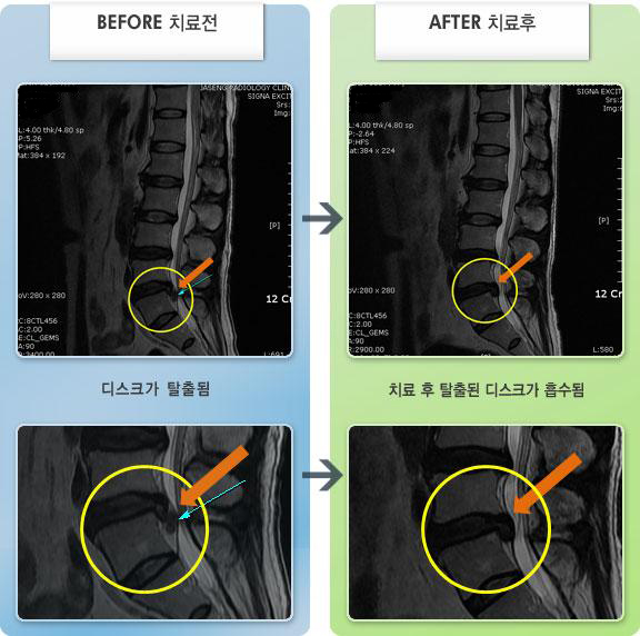 자생한방병원 치료사례 MRI로 보는 치료결과-허리 통증과 오른쪽 엉치에서 종아리까지 많이 당기고 저림