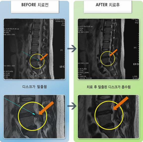 자생한방병원 치료사례 MRI로 보는 치료결과-전날 무거운 것을 들고 허리 통증이 심하여 보행이 불가능한 상태
