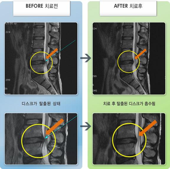 자생한방병원 치료사례 MRI로 보는 치료결과-오른쪽 허리 통증