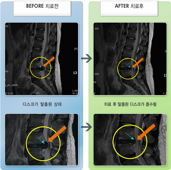 자생한방병원 치료사례 MRI로 보는 치료결과-허리와 다리 저림 증상으로 수면시 밤에 자주 깸