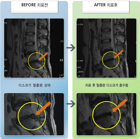 자생한방병원 치료사례 MRI로 보는 치료결과-허리 통증과 좌측 하지 방산통으로 앉았다 서거나 허리 숙일때 통증