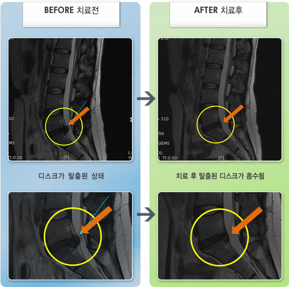 자생한방병원 치료사례 MRI로 보는 치료결과-허리 통증으로 움직임이 제한되고 앉아 있을때 통증