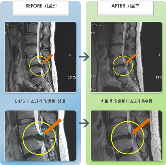 자생한방병원 치료사례 MRI로 보는 치료결과-허리 통증과 양쪽 다리가 저려서 걸을때 마다 저리고, 힘이 없어 절뚝거렸다.