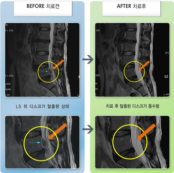 자생한방병원 치료사례 MRI로 보는 치료결과-좌측 다리 저림과 족배굴곡근 약화로 인한 보행제한