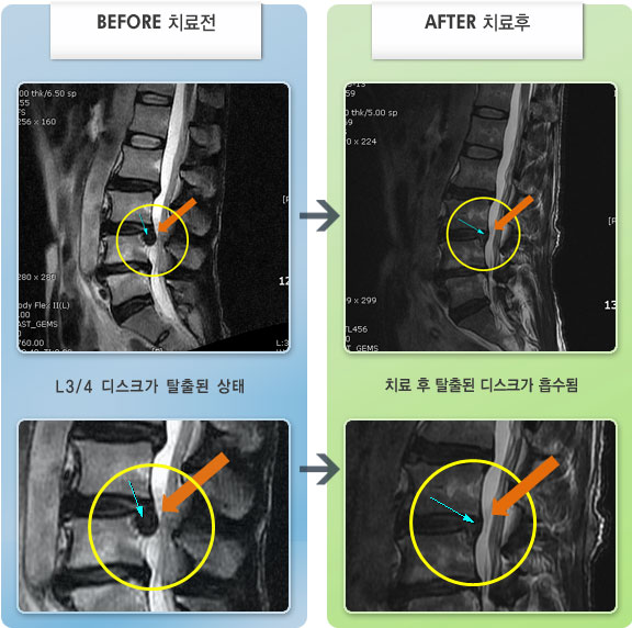 자생한방병원 치료사례 MRI로 보는 치료결과-오른쪽 다리 방사통이 극심하여 누워있어도 통증 발생