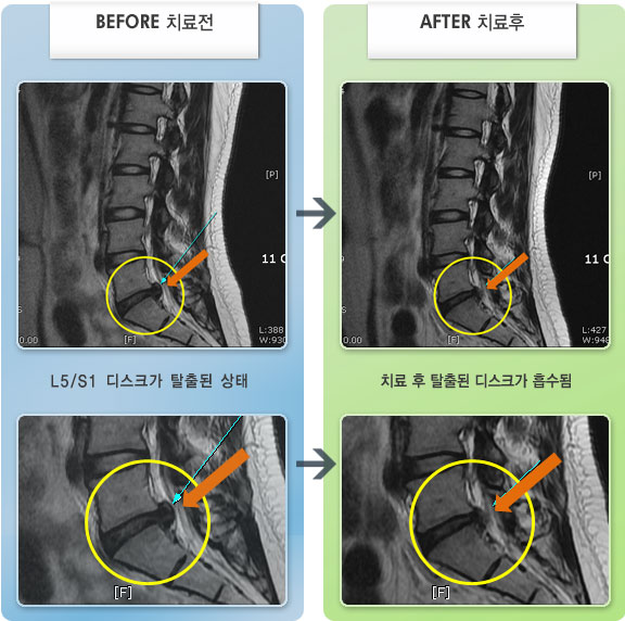 자생한방병원 치료사례 MRI로 보는 치료결과-골반이 틀어져 다리 들기가 힘들어 걷기 어려운 상태라 절룩거리며 보행