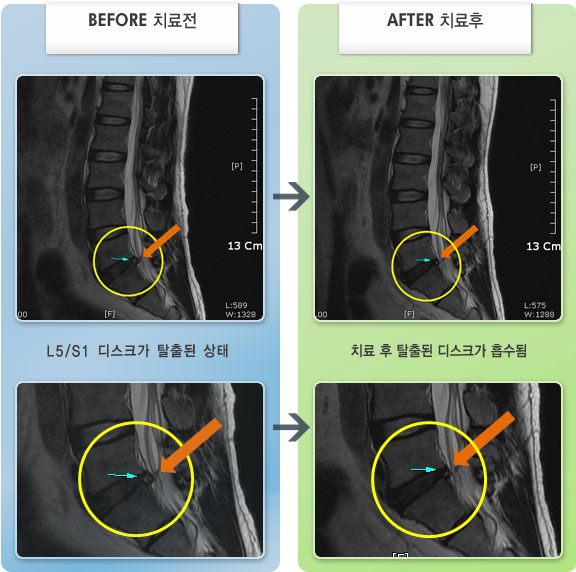 자생한방병원 치료사례 MRI로 보는 치료결과-허리 통증이 심하고 왼쪽 엉치, 종아리 통증