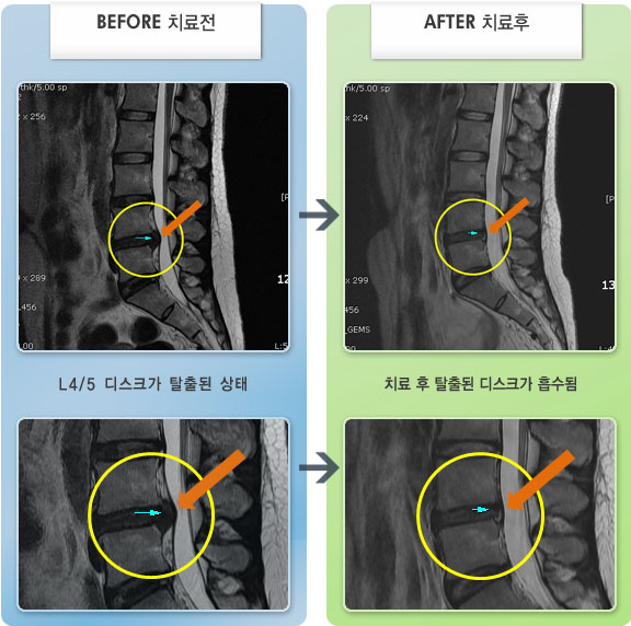 자생한방병원 치료사례 MRI로 보는 치료결과-허리 통증 및 다리 통증으로 조금도 움직일수 없는 상태