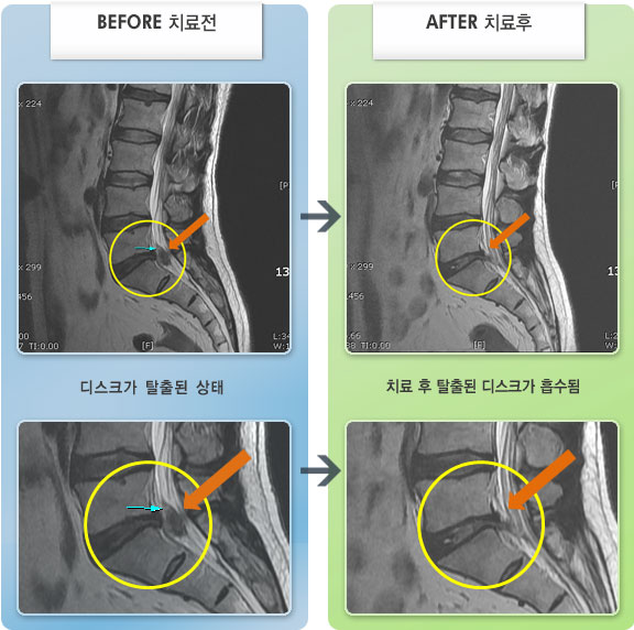 자생한방병원 치료사례 MRI로 보는 치료결과-무거운 물건을 들다 허리 삐끗하여 앉아 있을때 통증