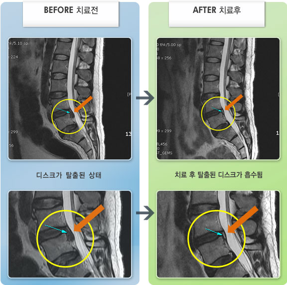 자생한방병원 치료사례 MRI로 보는 치료결과-왼쪽 다리 통증이 제일 심하고, 걷기도, 서 있기도 힘들어 일상생활이 거의 불가능한 상태