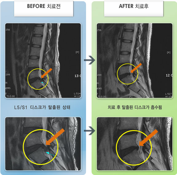 자생한방병원 치료사례 MRI로 보는 치료결과-허리 통증과 오른쪽 다리 통증