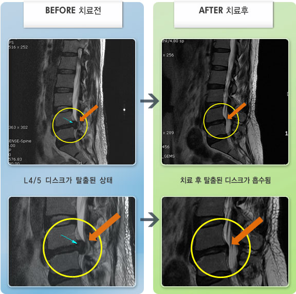 자생한방병원 치료사례 MRI로 보는 치료결과-왼쪽 둔부에서 종아리 뒤로 저리고 당기며 족배굴이 마비