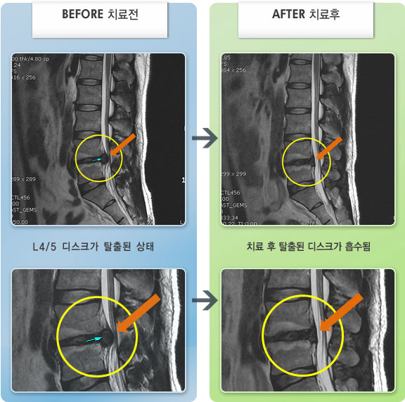 자생한방병원 치료사례 MRI로 보는 치료결과-허리부터 좌측 허벅지 종아리까지 통증