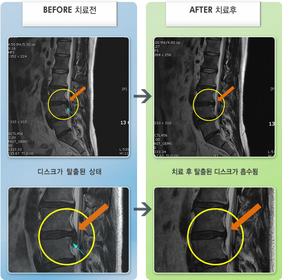 자생한방병원 치료사례 MRI로 보는 치료결과-허리 통증 및 다리 당김 