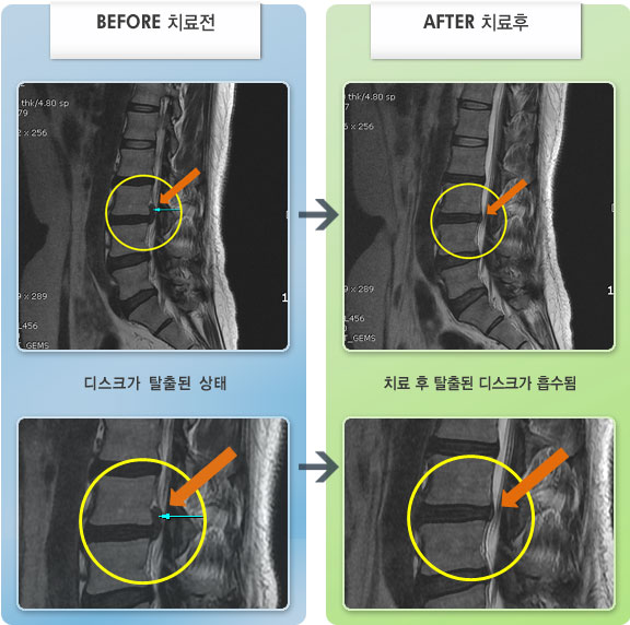 자생한방병원 치료사례 MRI로 보는 치료결과-허리 통증과 좌측 엉치부 통증으로 서기가 힘들고 바로 누워 다리를 펴기도 힘든 상태