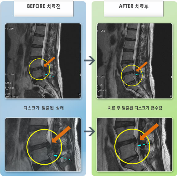자생한방병원 치료사례 MRI로 보는 치료결과-허리 통증이 심하고 좌측으로 발목까지 다리 통증