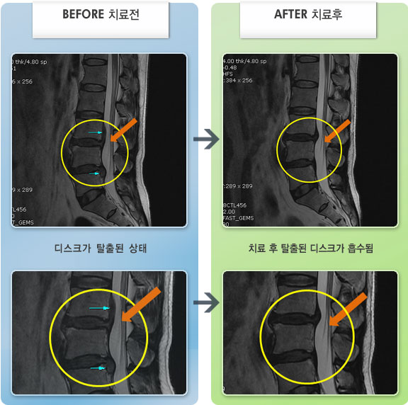 자생한방병원 치료사례 MRI로 보는 치료결과-우측 무릎, 대퇴 내측으로 마비오는 듯한 저림 증상과 우측 엉치, 사타구니 쪽으로 통증