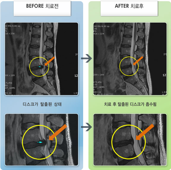 자생한방병원 치료사례 MRI로 보는 치료결과-보상성 측만증으로 우측 엉치에서 종아리 통증