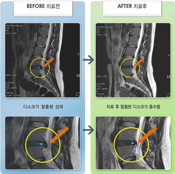 자생한방병원 치료사례 MRI로 보는 치료결과-아기 안다 삐끗하여 심한 허리통증