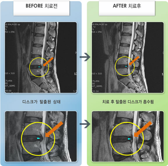 자생한방병원 치료사례 MRI로 보는 치료결과-물건 들다 허리를 삐끗하여 허리와 우측 다리 통증