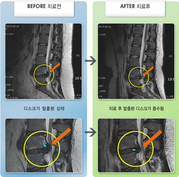 자생한방병원 치료사례 MRI로 보는 치료결과-우측 허리 통증