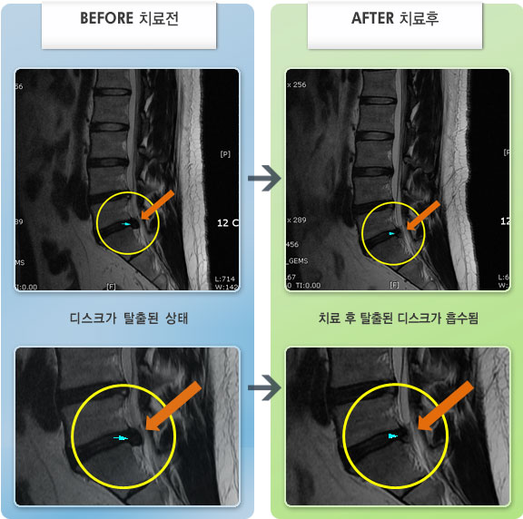 자생한방병원 치료사례 MRI로 보는 치료결과-허리의 통증과 우측 다리 통증