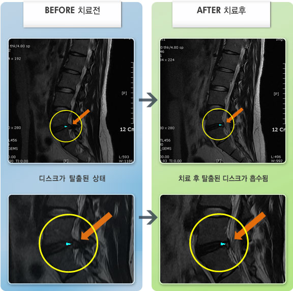 자생한방병원 치료사례 MRI로 보는 치료결과-디스크 파열로 우측 엉치 부터 종아리까지 저림 및 마비감