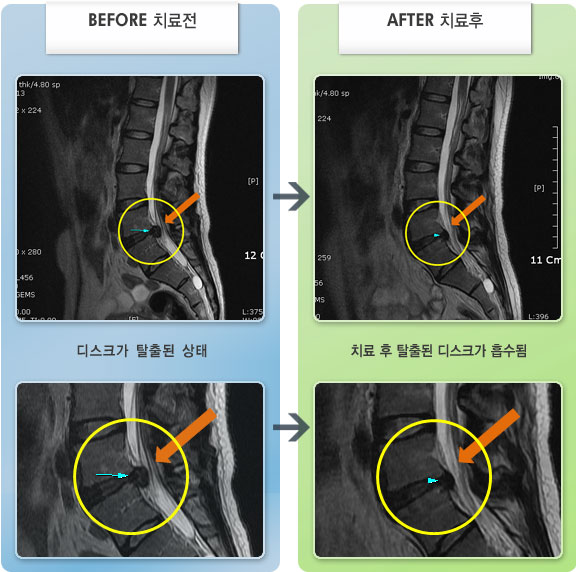 자생한방병원 치료사례 MRI로 보는 치료결과-좌측 허벅지부터 종아리 까지 심한 저림증상