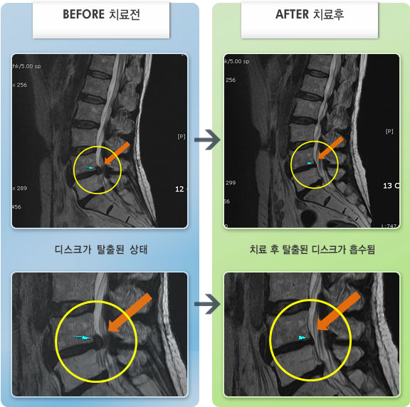 자생한방병원 치료사례 MRI로 보는 치료결과-허리 숙일때 통증이 있고 보행시 왼쪽 종아리 저림
