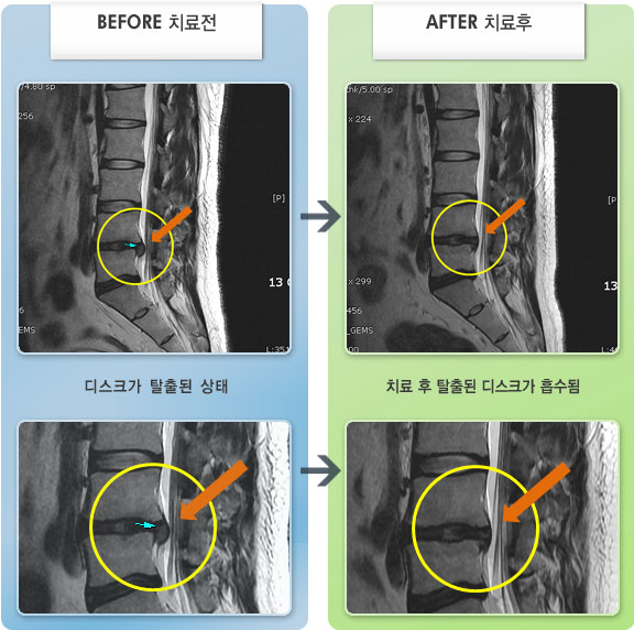 자생한방병원 치료사례 MRI로 보는 치료결과-기립시 및 요부 굴곡시 허리 통증이 증가