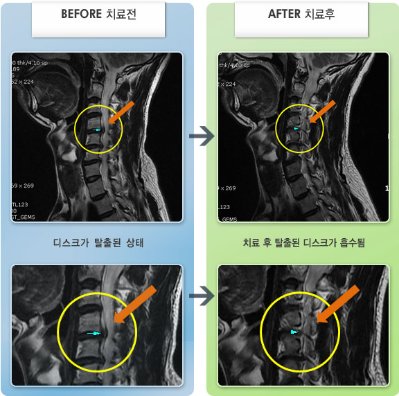 자생한방병원 치료사례 MRI로 보는 치료결과-목과 우측 어깨 통증 및 우측 상지 근력저하가 있었다.