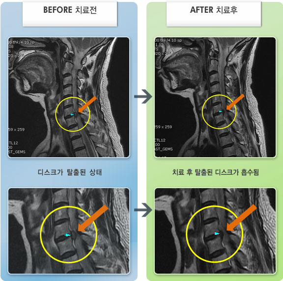 자생한방병원 치료사례 MRI로 보는 치료결과-왼쪽 상지 저림 및 경항통, 양쪽 등 통증