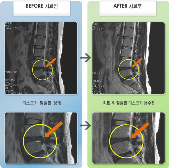 자생한방병원 치료사례 MRI로 보는 치료결과-왼쪽 다리 저림 및 근력 저하 증상
