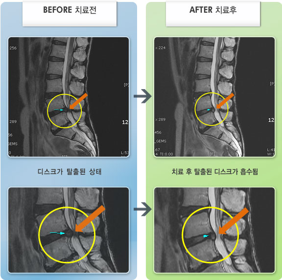 자생한방병원 치료사례 MRI로 보는 치료결과-외관상으로 골반이 확 틀어져 있는 상태이며 허리 및 우측 다리 통증