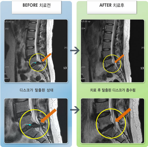 자생한방병원 치료사례 MRI로 보는 치료결과-허리와 우측 엉치 통증이 극심하여 굽히거나 펴지 못하고 앉아있기도 힘든 상태