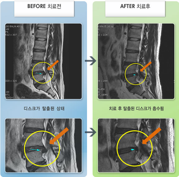 자생한방병원 치료사례 MRI로 보는 치료결과-자전거 타다 넘어지면서 허리 통증 및 둔부, 다리 통증