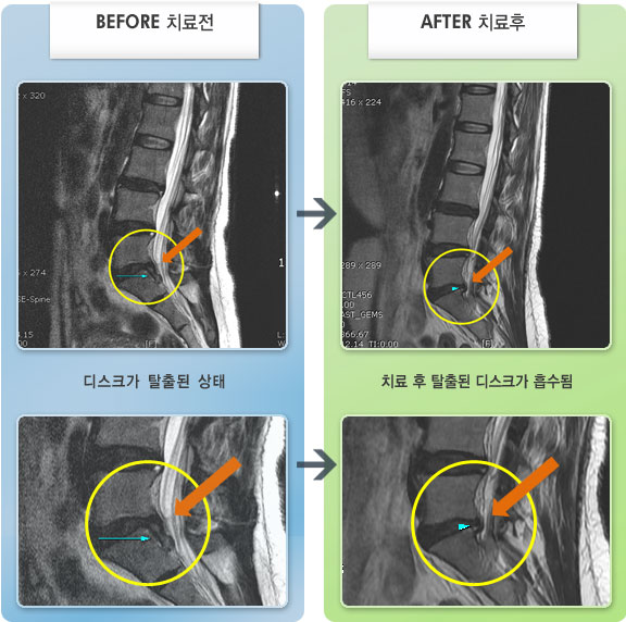 자생한방병원 치료사례 MRI로 보는 치료결과-허리 통증과 우측 다리 통증 및 저림이 심하였다.