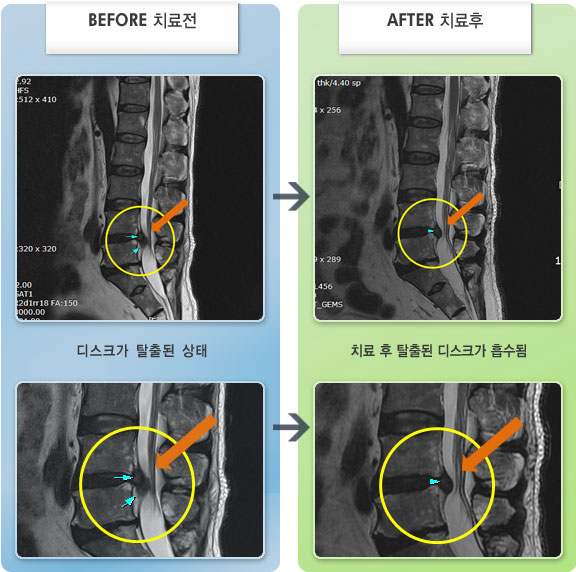 자생한방병원 치료사례 MRI로 보는 치료결과-요통 및 좌하지 저린감이 4,5지 발가락까지 있는 상태