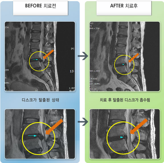 자생한방병원 치료사례 MRI로 보는 치료결과-요통 및 좌하지 통증이 심하여 반듯이 눕기도 힘들었다.