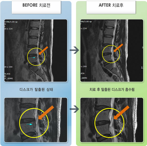 자생한방병원 치료사례 MRI로 보는 치료결과-우측 요통, 우측 둔부에서 종아리까지 방사통이 있었다.